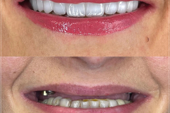 dental-implants-crowns