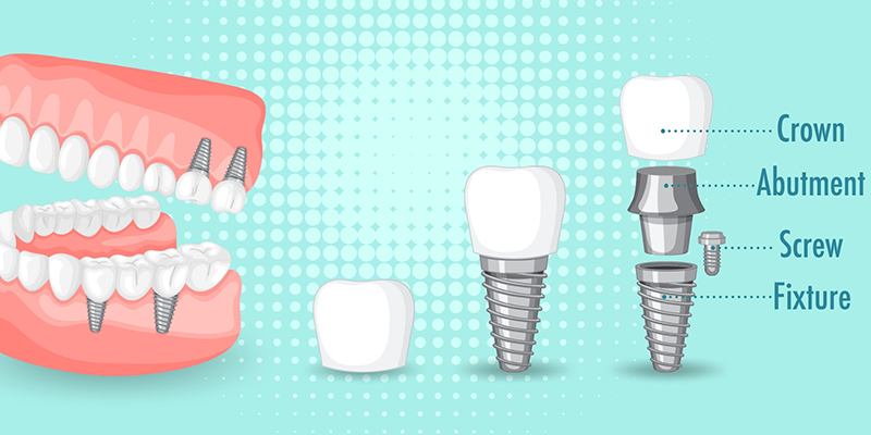 What Are The 4 Types Of Implants?