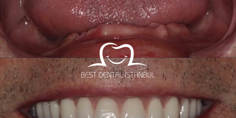 Full Mouth Dental Implants In Turkey: Price List&Package Deals 2023