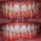 emax veneers turkey before after
