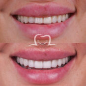 what is emax veneers